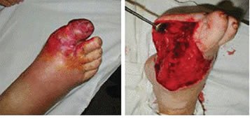 в Москве из-за несвоевременной госпитализации 35-летнего мужчины с флегмоной стопы, больному пришлось ампутировать большой палец на ноге